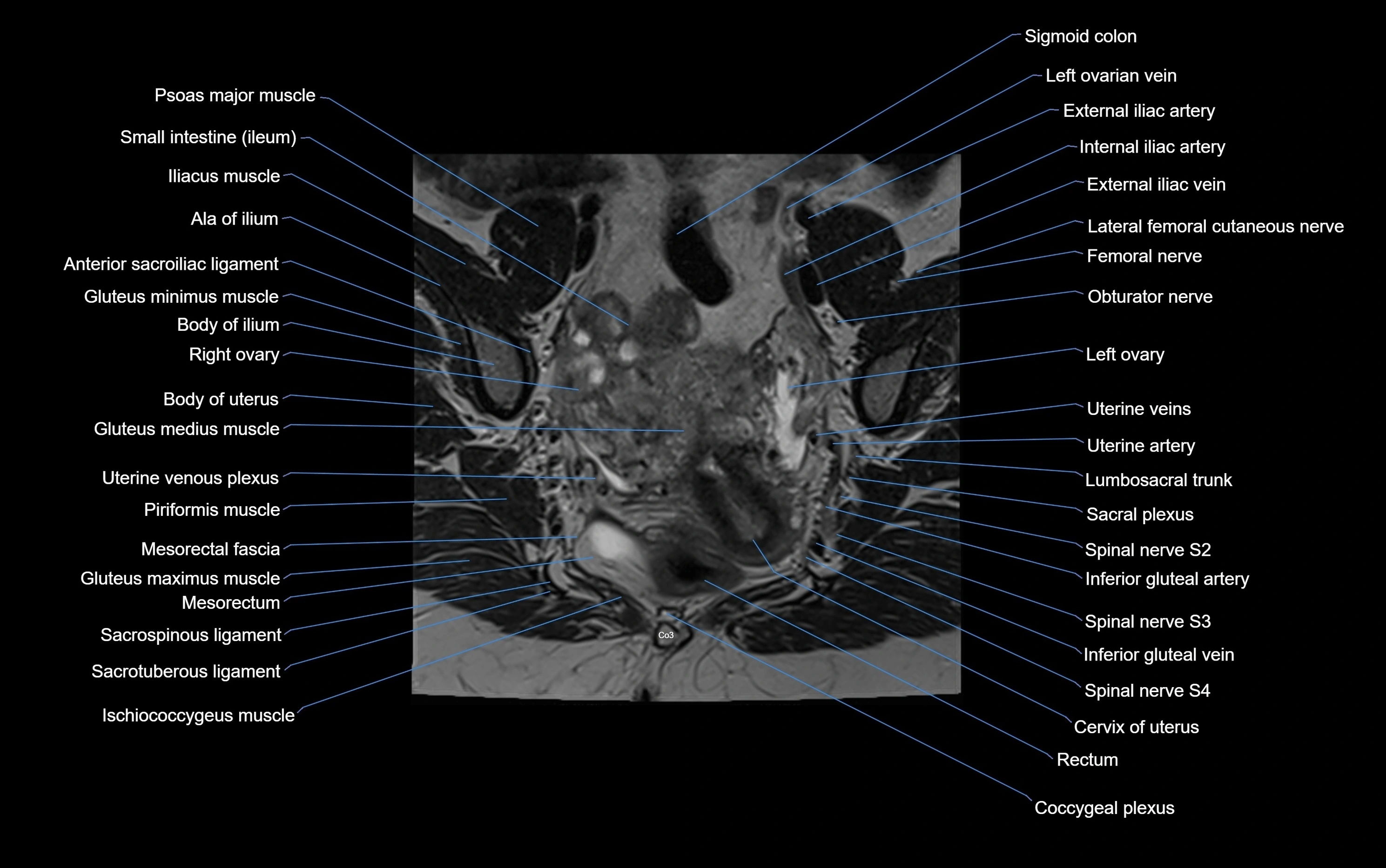 MRI sacroiliac joint coronal cross sectional anatomy  radiology  image-img-00001-00003.webp